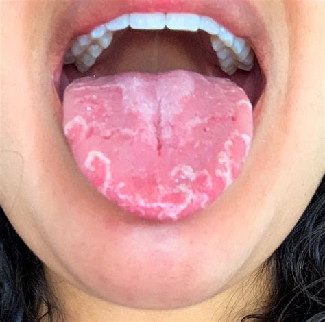 geographic tongue clinic neo