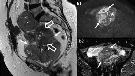 mri in a 56 year old woman shows a heterogeneous uterine mass with