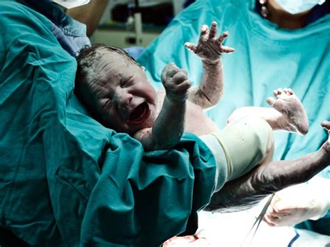 episiotomy rate continues steady decline medpage today