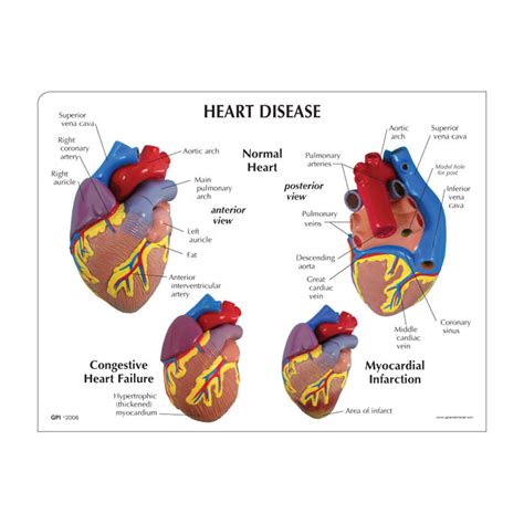 heart disease model set health edco anatomical models