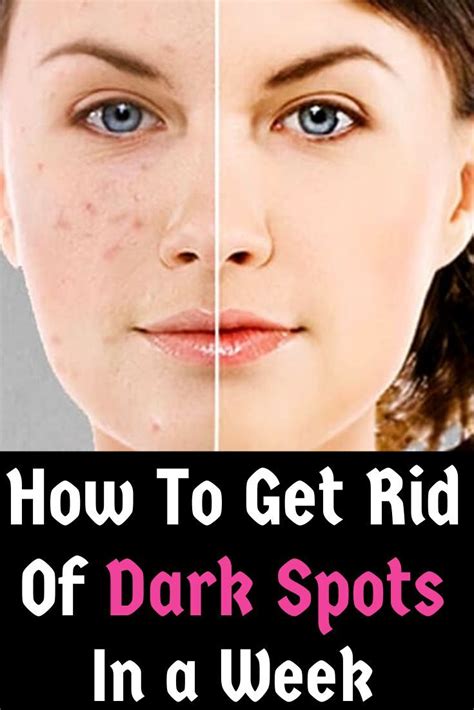 how to get rid of dark spots in a week dark spots on face remove