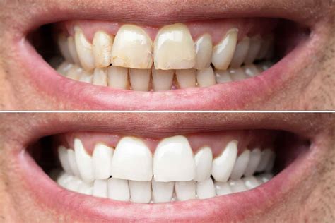 teeth whitening smiles  matter