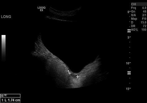 Sonographic Detection Of Mayer Rokitansky Küster Hauser Syndrome