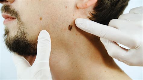 Are Moles Cancerous How To Tell If Your Moles May Be Cancer Spot