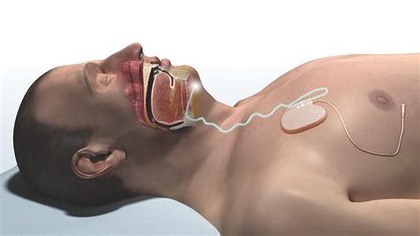 ogden sleep apnea surgery inspire sleep implant douglas anderson