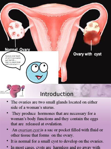 Ovarian Cyst Ovarian Cancer Ovary