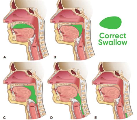 How To Swallow Correctly While Mewing Ach