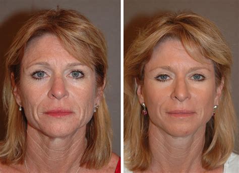 long     recover   facelift