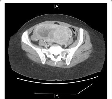 ct scan of abdomen and pelvis enlarged uterus with a markedly hot sex