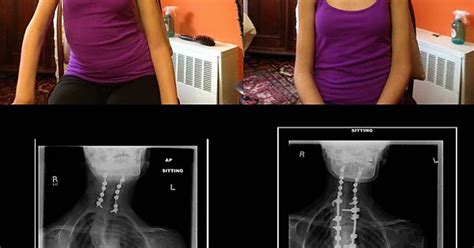 X Rays And Pictures Of Me Before And After My Spinal