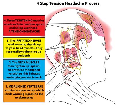 cervicogenic tension headaches physiotherapy  cornerstone therapy