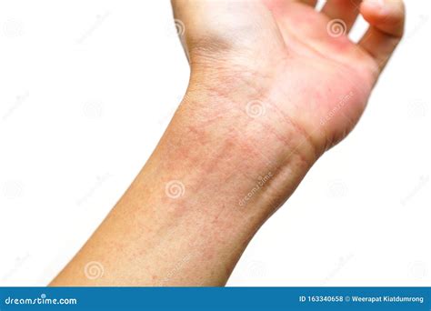 red rash  wrist stock photo image  copy medical