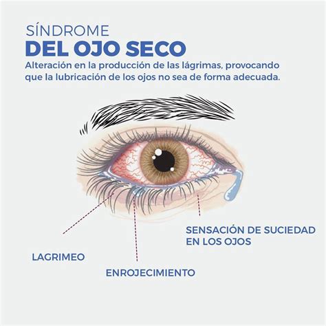 síndrome del ojo seco idoca