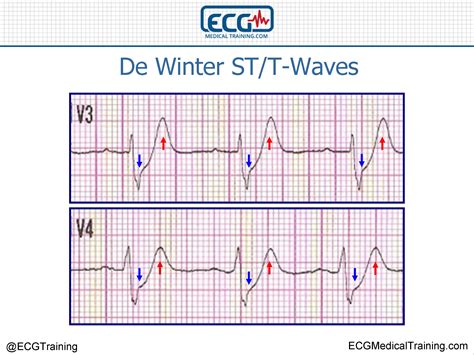 de winter stt waves ecg medical training
