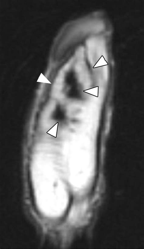 mr imaging of nonmalignant penile lesions radiographics