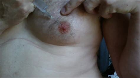 Male Nipples Saline Injection During Scrotal Infusion