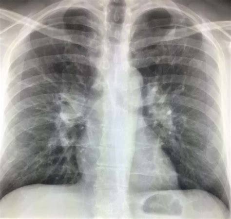 Bilateral Hilar Prominence On Chest X Ray – Radiology In Plain English