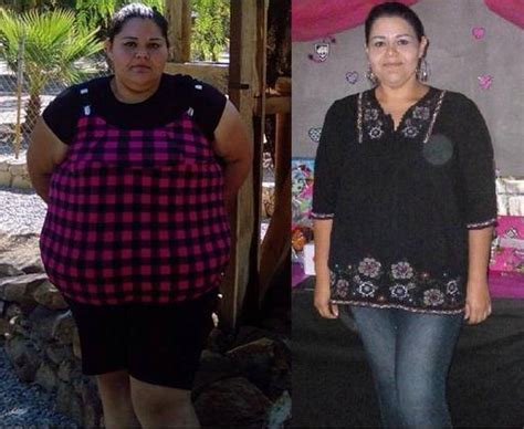 Safe And Affordable Gastric Sleeve Plication Surgery In Tijuana Mexico