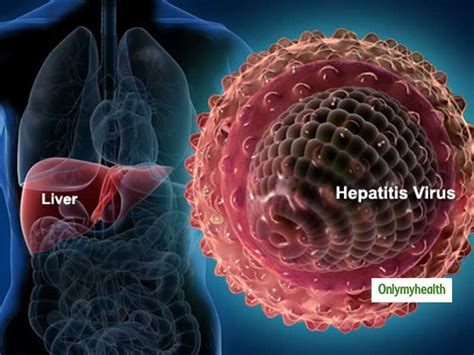 hepatitis  safe  viral hepatitis   expert tips onlymyhealth