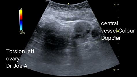 partial torsion left ovary ultrasound video youtube