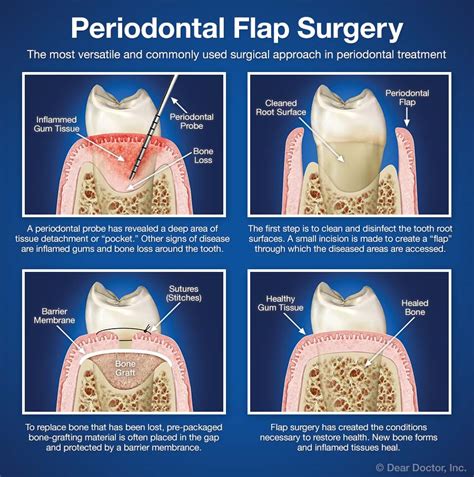 periodontal flap surgery coastal periodontics implant dentistry p