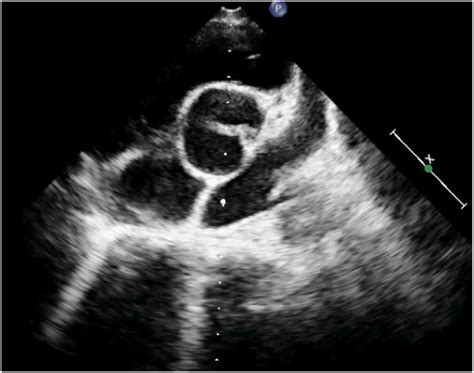 Echocardiography Prasternal Short Axis View Showing Unicuspid Aortic