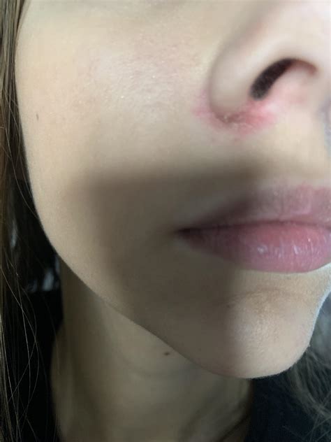 skin concerns dry irritated red bumpy flaking skin  nose
