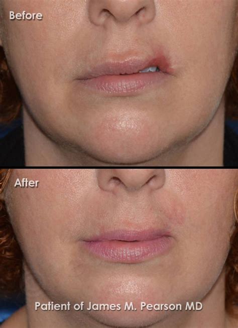 pearson lip reconstructive surgery     dr