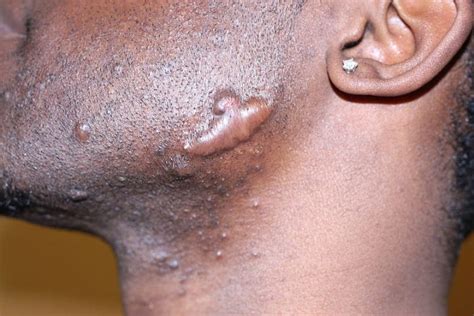 keloid scar treatment    lost  skinpractice