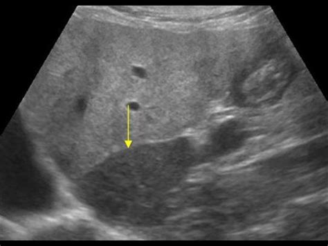 Abdomen And Retroperitoneum 1 1 Liver Case 1 1 11