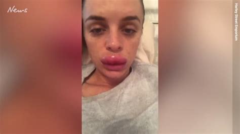 woman reveals why she got lip fillers at 19 au — australia s