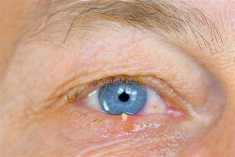 eyelid bumps    identify styes milia pimples allure