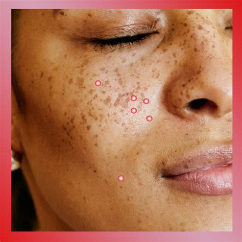 acne treatment   type  acne glamour