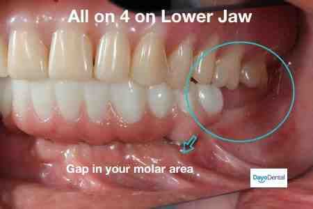 clean    dental implants dental news network