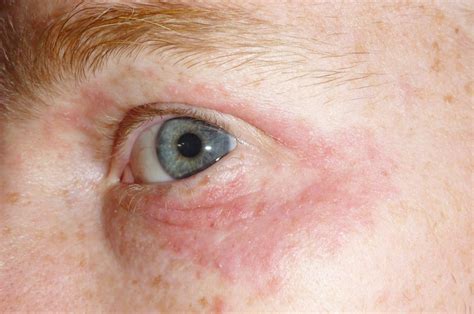 rash  eyes learn  symptoms