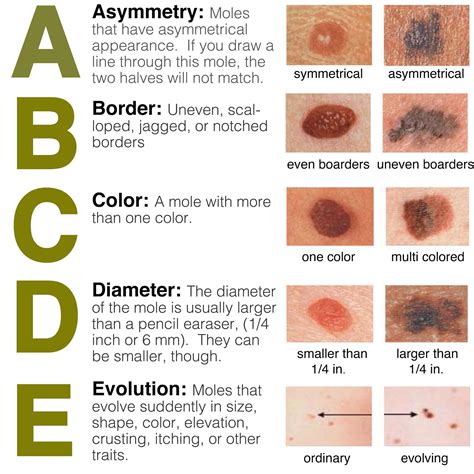 abcde rule  skin cancer detection
