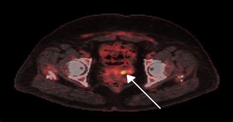 cureus uterine tumor resembling sex cord tumor a case