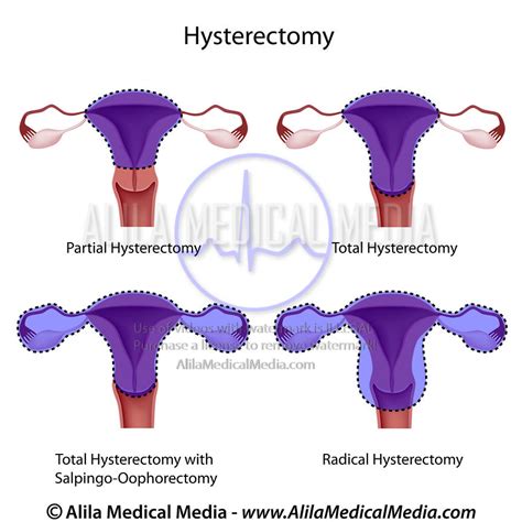 Alila Medical Media Hysterectomy Surgical Removal Of The Uterus