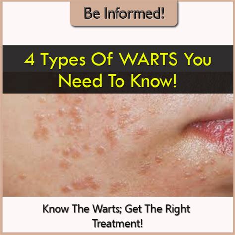 Wart Remover Tips 4 Types Of Warts Which One Do You