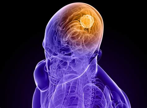 rak zlosliwy mozgu moze dopasc kazdego poznaj jego objawy zdjecie