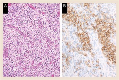pathology and pathogenesis of t cell lymphoma clinical lymphoma