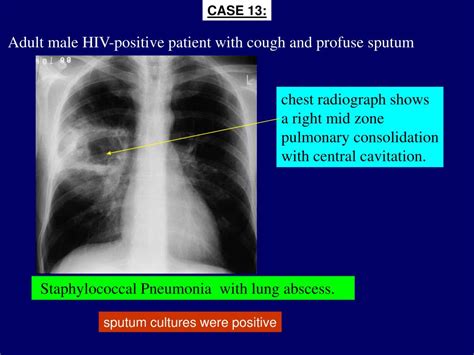 Ppt Approach To Radiological Diagnosis Of Pulmonary Infections In