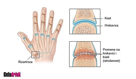 rizartroza artroza sake rizartritis