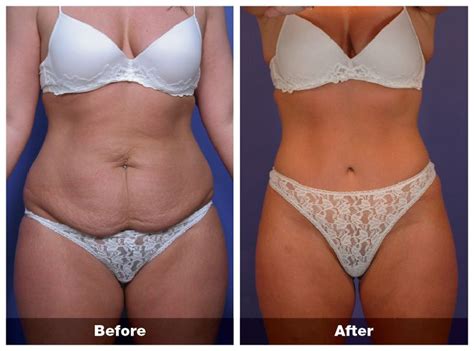 76 Best Images About Plastic Surgery Good And The Bad On