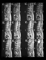 Photos of What Is Lumbar Stenosis