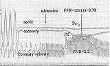 Kern Coronary Pressure Distal Flow Increasing Increases Proportion Stenosis Figure Through sketch template