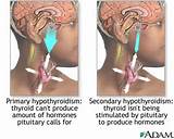 Images of Symptoms Of A Pituitary Tumor