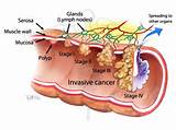 Colon Cancer Spread To Lymph Nodes Pictures