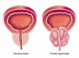 Photos of Malignant Tumor Of The Prostate Gland