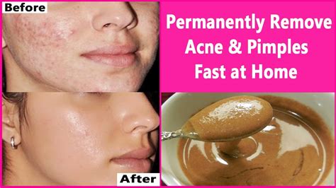 cure acne naturally  permanently yeediot